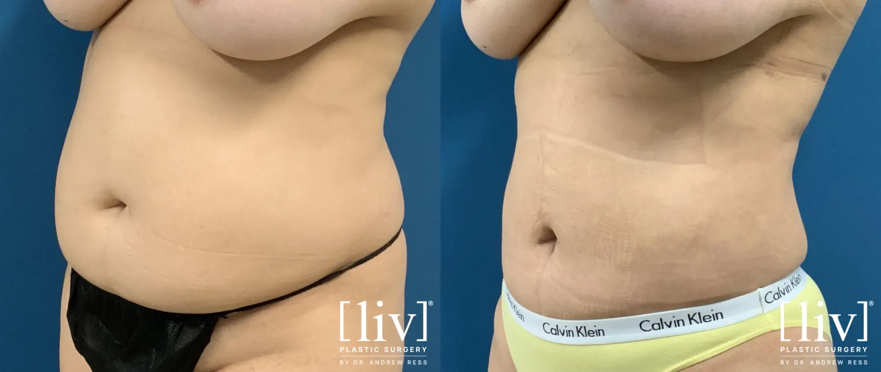 Liposuction: Patient 41 - Before and After 2