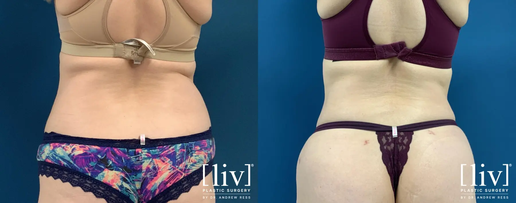 Liposuction: Patient 39 - Before and After 1