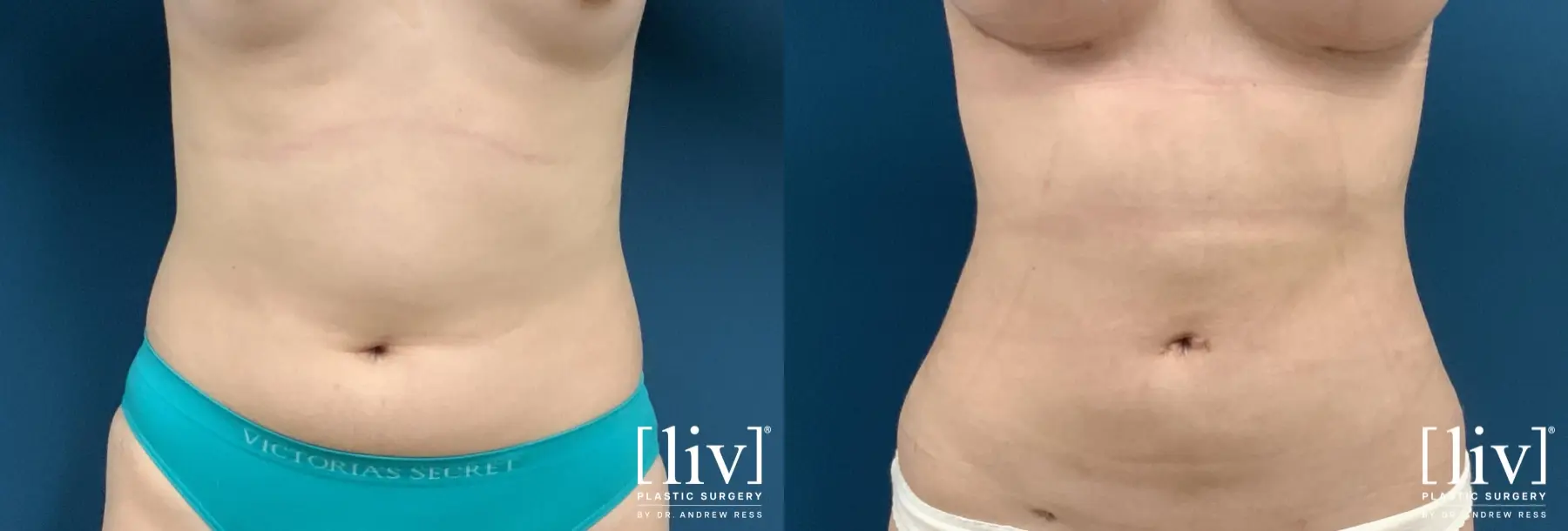 Liposuction: Patient 32 - Before and After 1