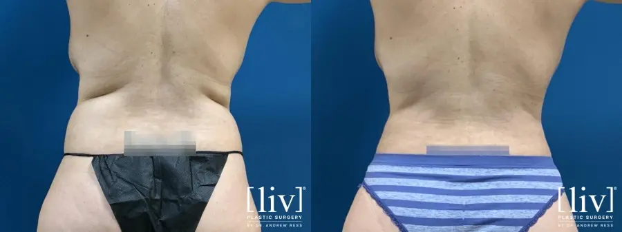 Liposuction: Patient 8 - Before and After 6