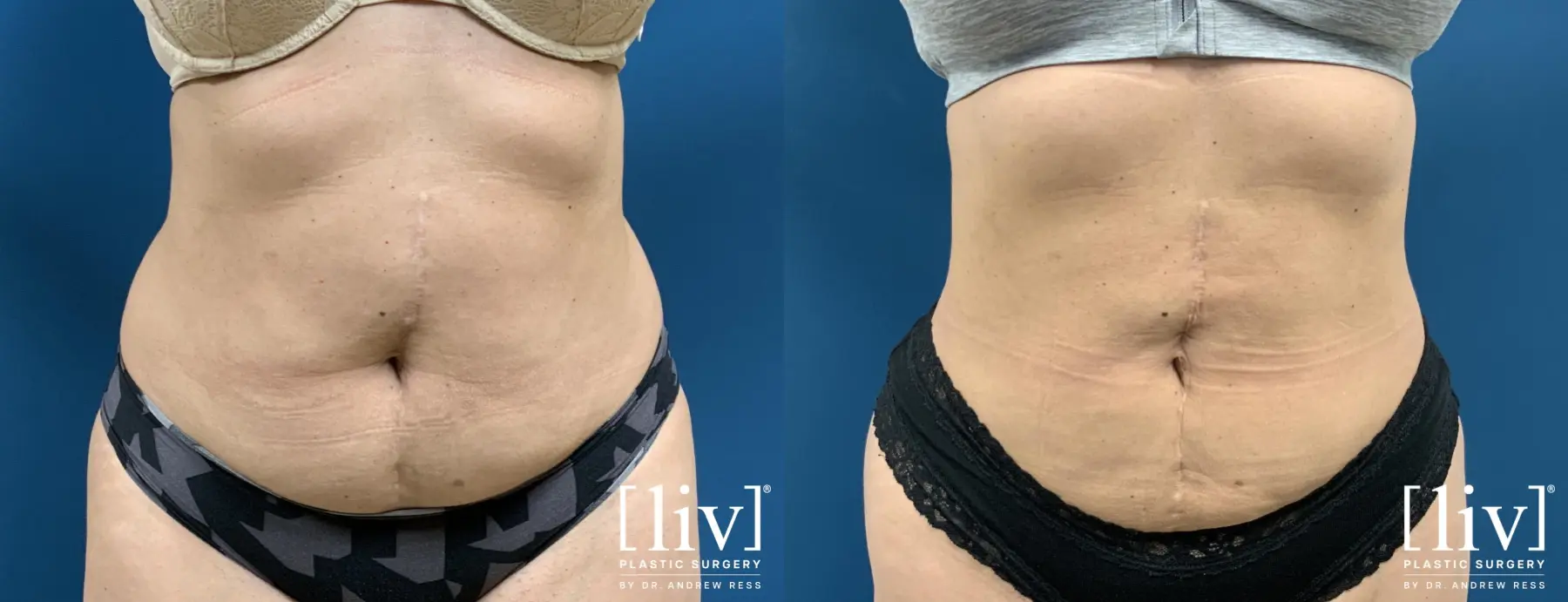 Liposuction: Patient 27 - Before and After 1