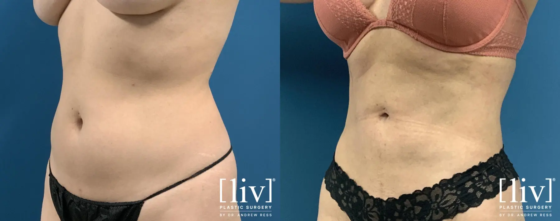 Liposuction: Patient 44 - Before and After 4
