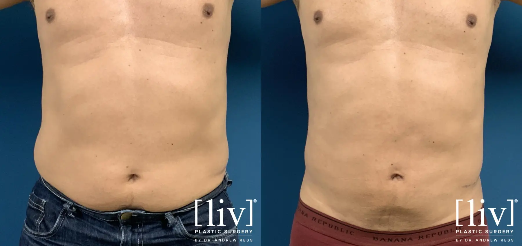 Men Liposuction - Before and After 1