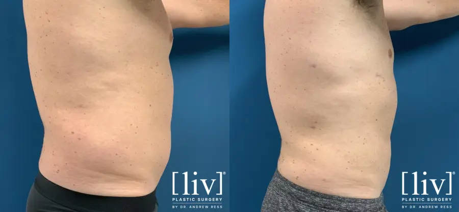 Men Liposuction - Before and After 5