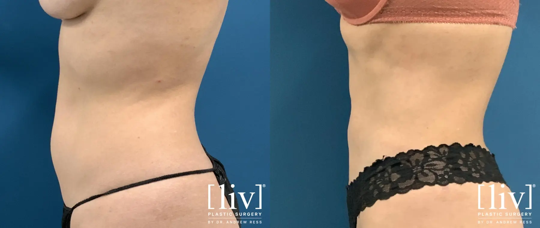 Liposuction: Patient 44 - Before and After 5