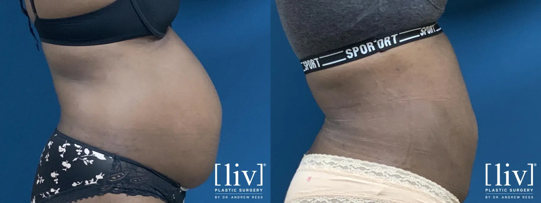 Liposuction - Before and After 5