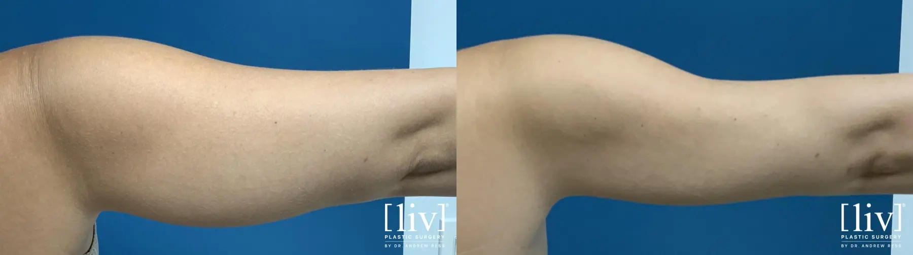 Arm Liposuction - Before and After 3