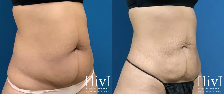 Liposuction: Patient 9 - Before and After 4