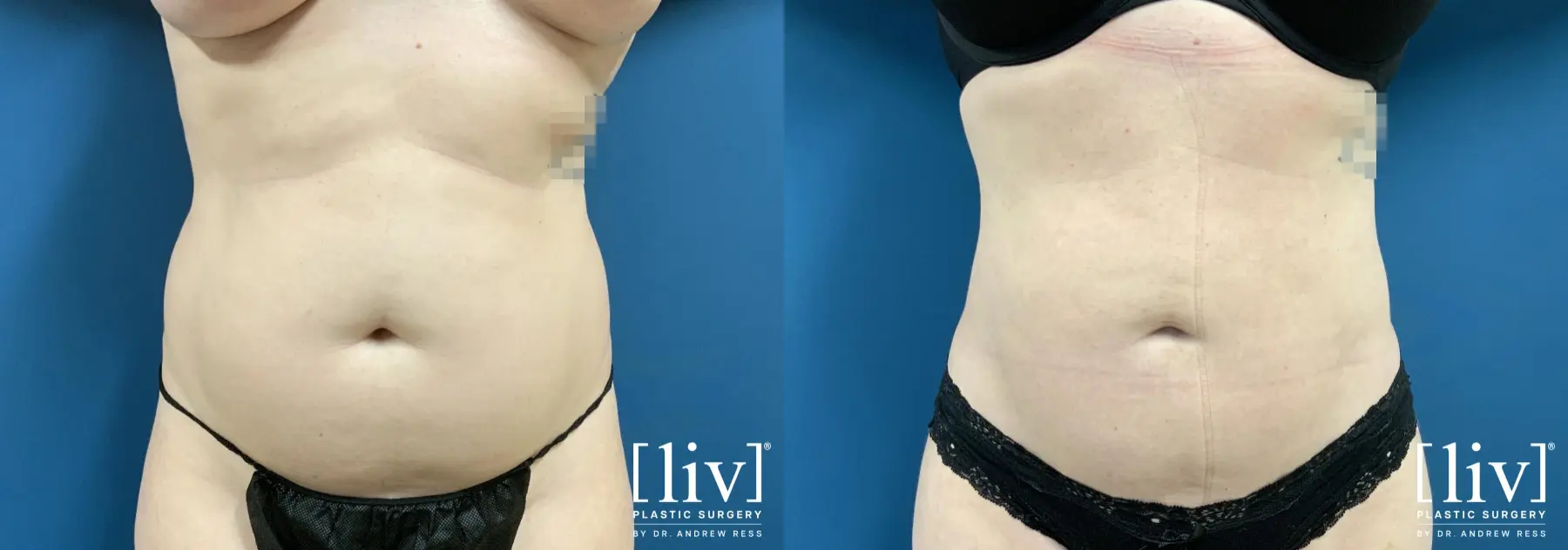 Liposuction: Patient 30 - Before and After 1