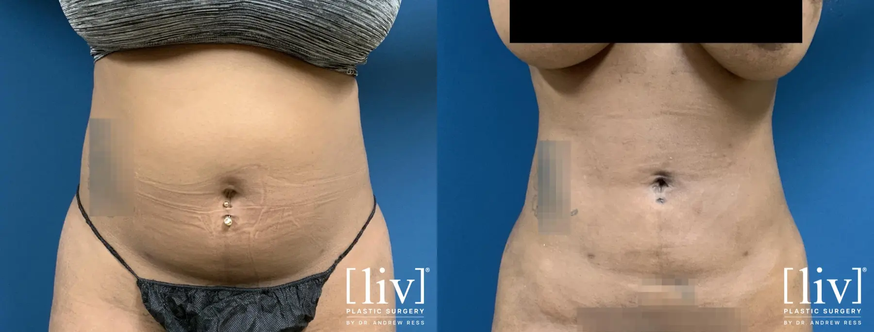 Liposuction: Patient 1 - Before and After  