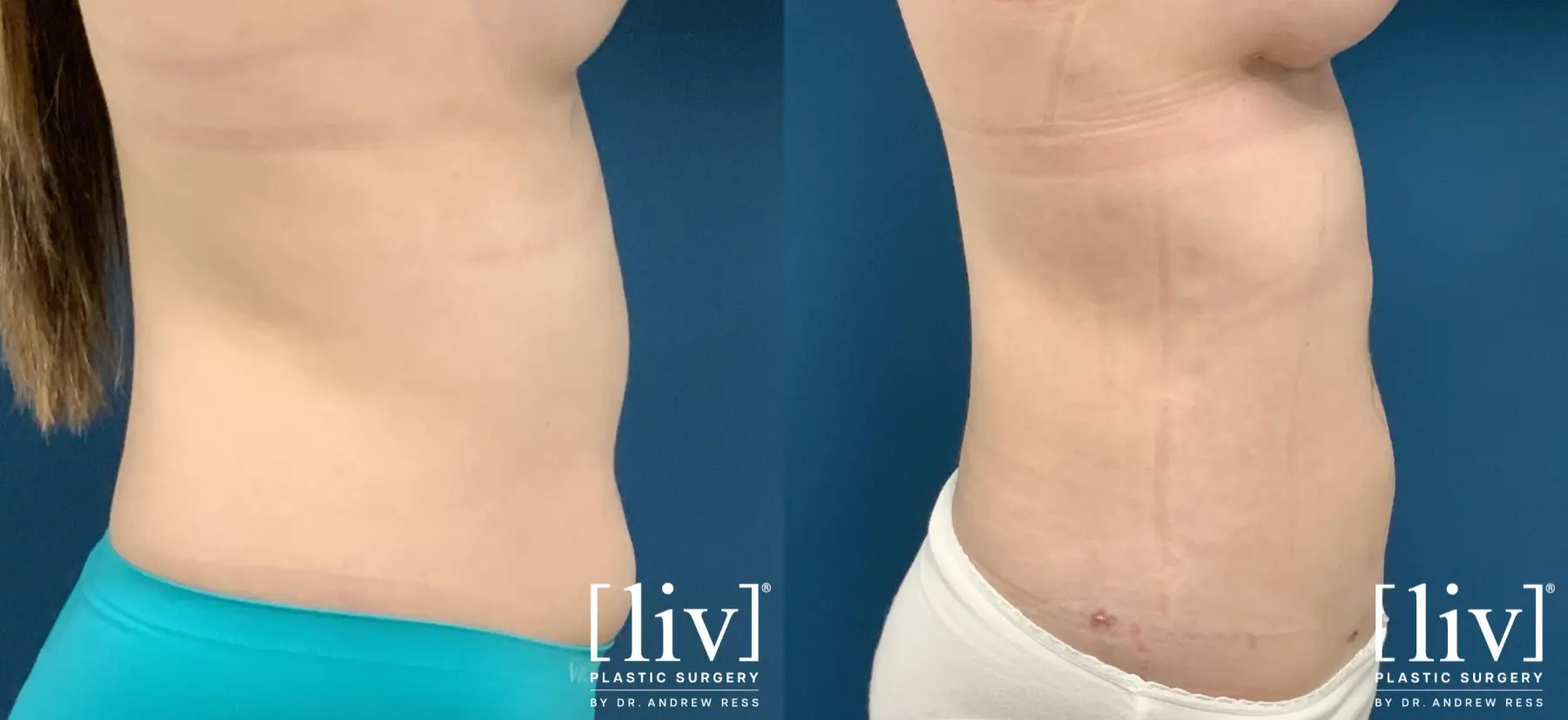 Liposuction: Patient 32 - Before and After 4