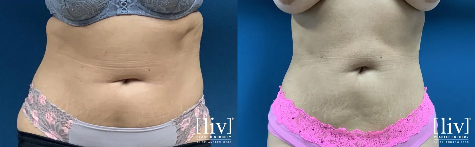 Liposuction: Patient 2 - Before and After  