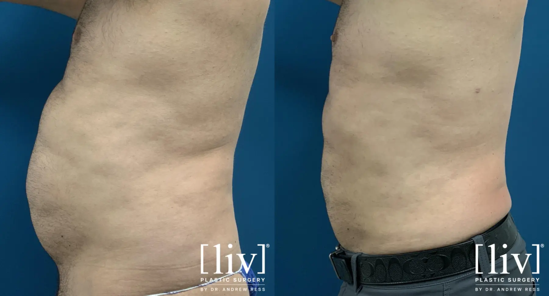 Men Liposuction - Before and After 3