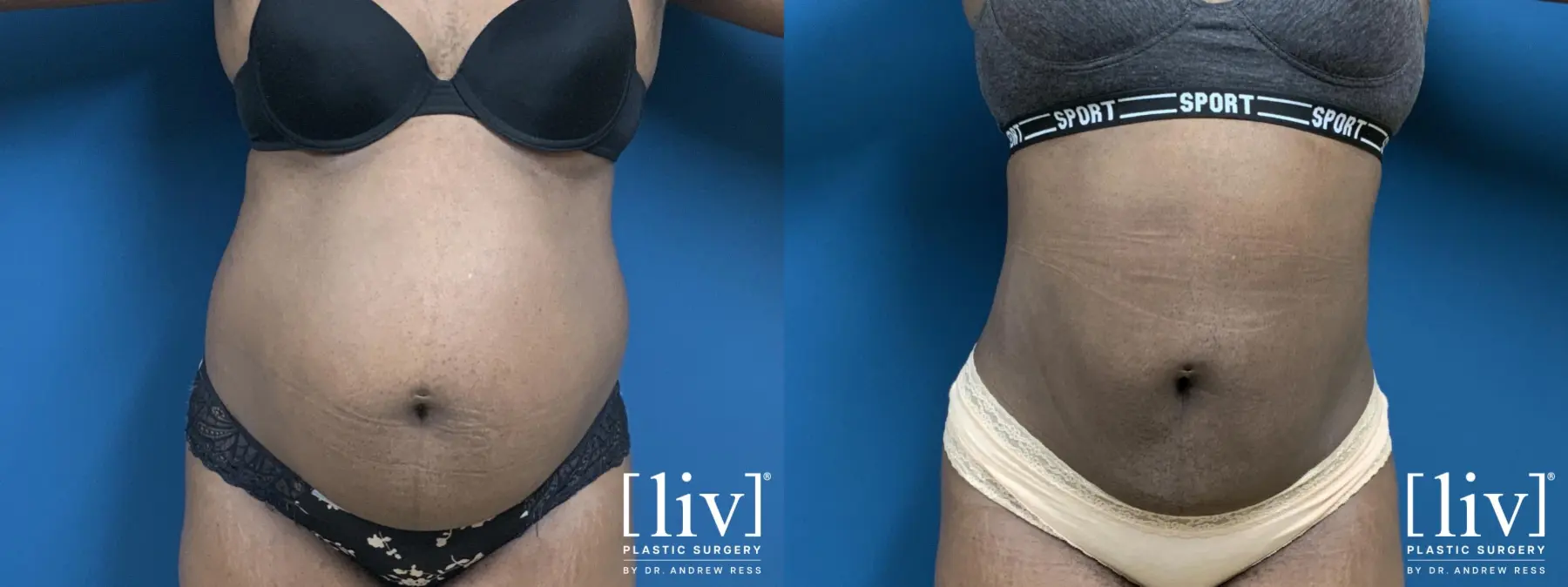 Liposuction - Before and After 3