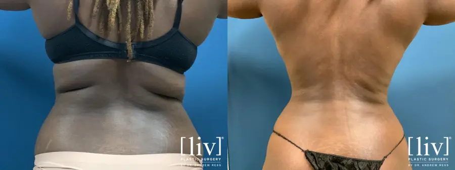 Liposuction: Patient 17 - Before and After 1