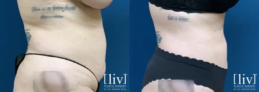 Liposuction: Patient 13 - Before and After 3
