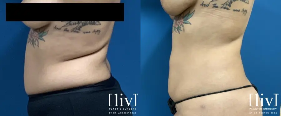 Liposuction: Patient 6 - Before and After 3