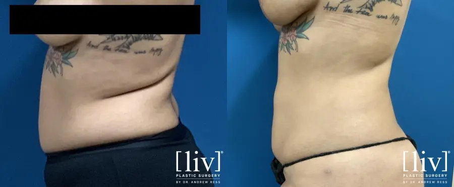 Liposuction: Patient 10 - Before and After 3