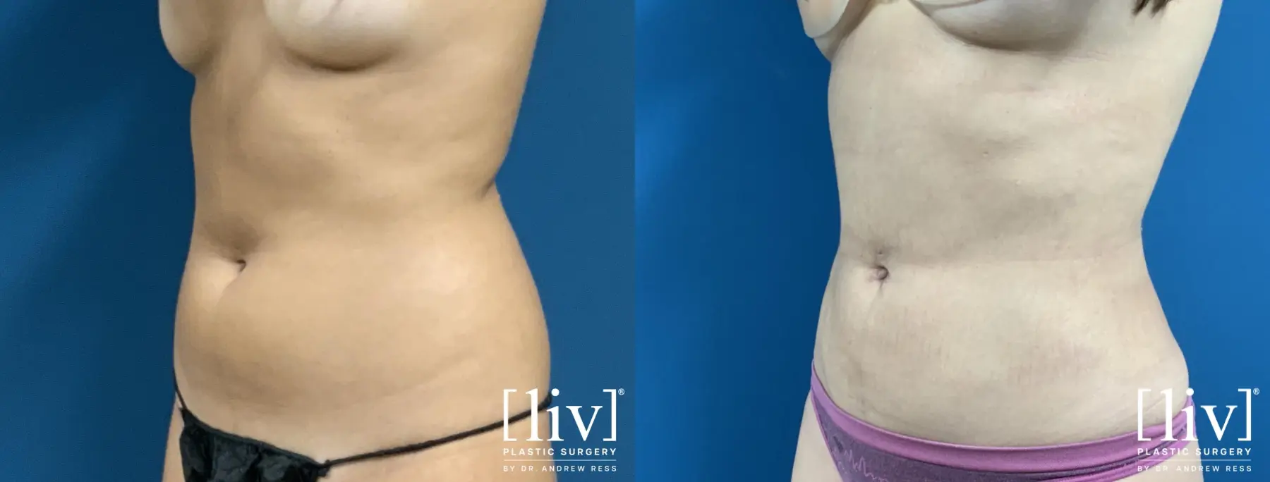Liposuction: Patient 25 - Before and After 2