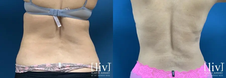 Liposuction: Patient 11 - Before and After 6