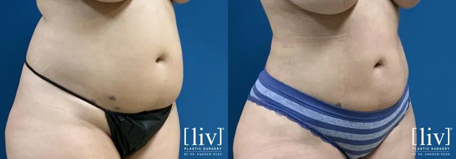 Liposuction: Patient 8 - Before and After 4