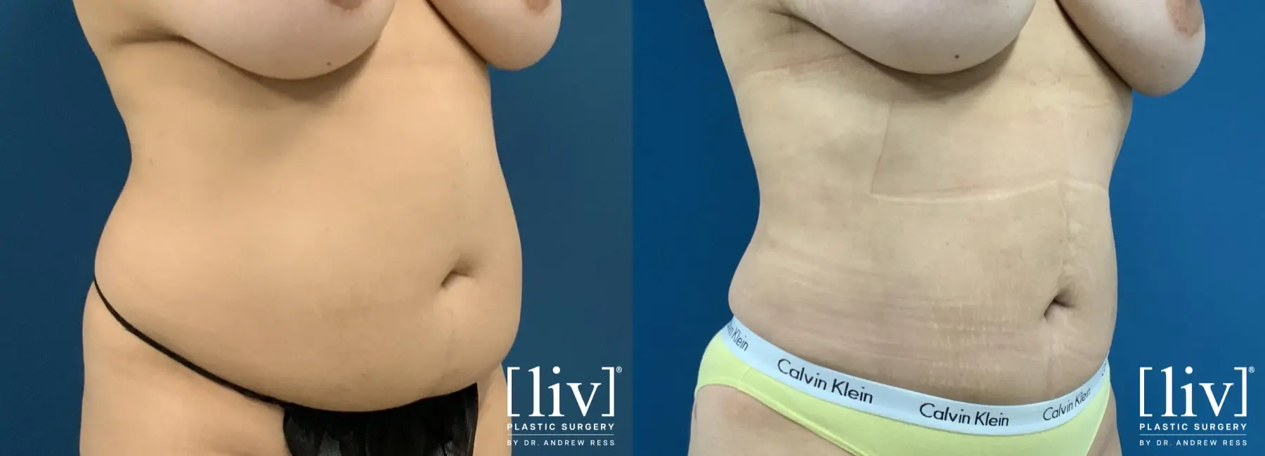 Liposuction: Patient 41 - Before and After 4