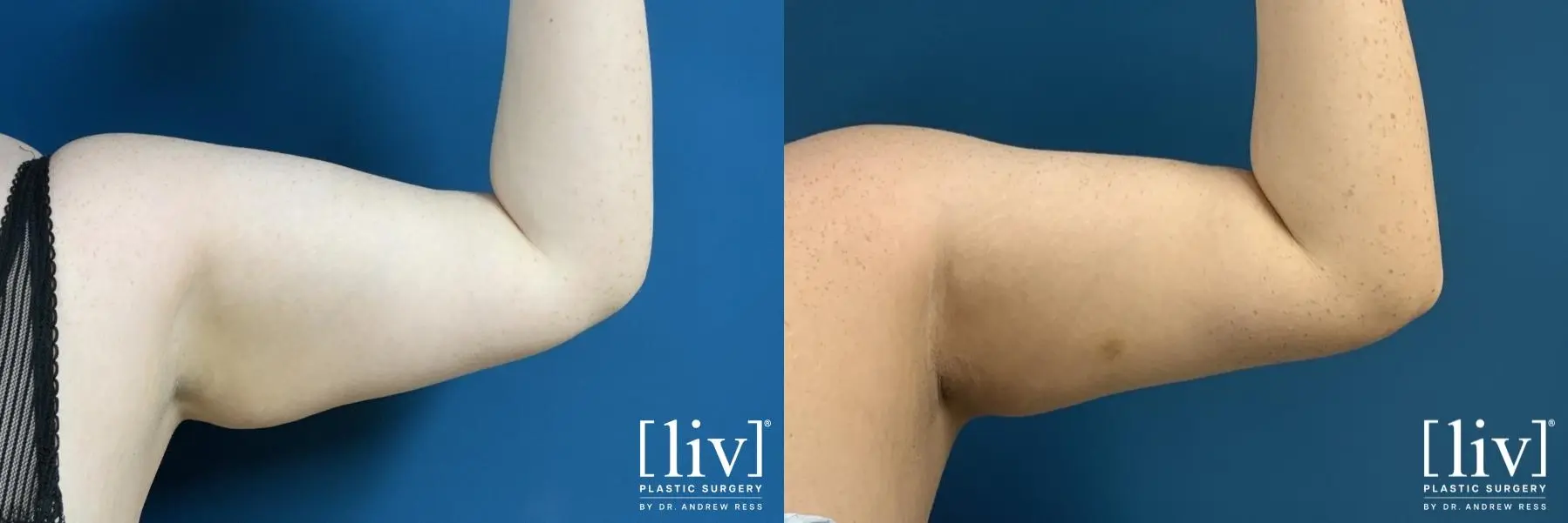 Arm Liposuction - Before and After 2