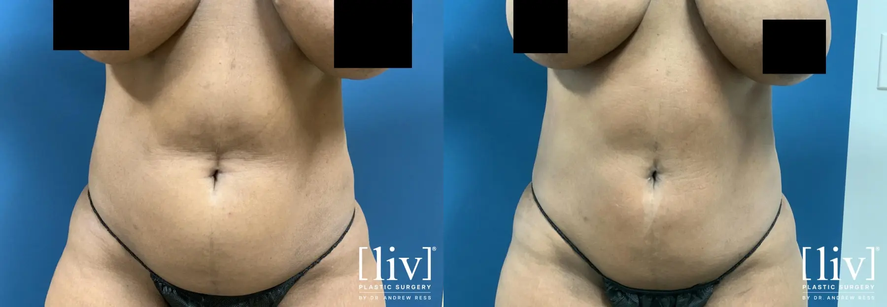 Liposuction: Patient 33 - Before and After 3