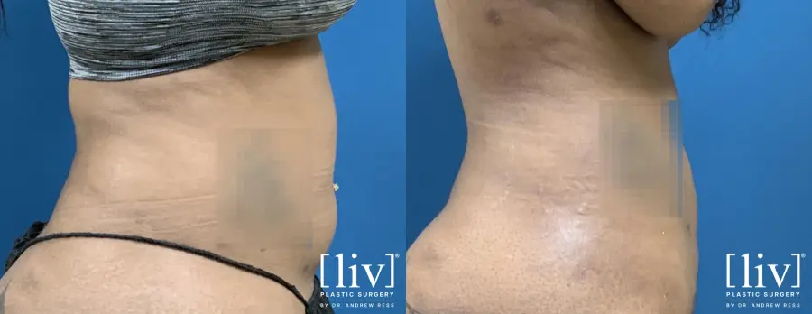 Liposuction: Patient 1 - Before and After 5