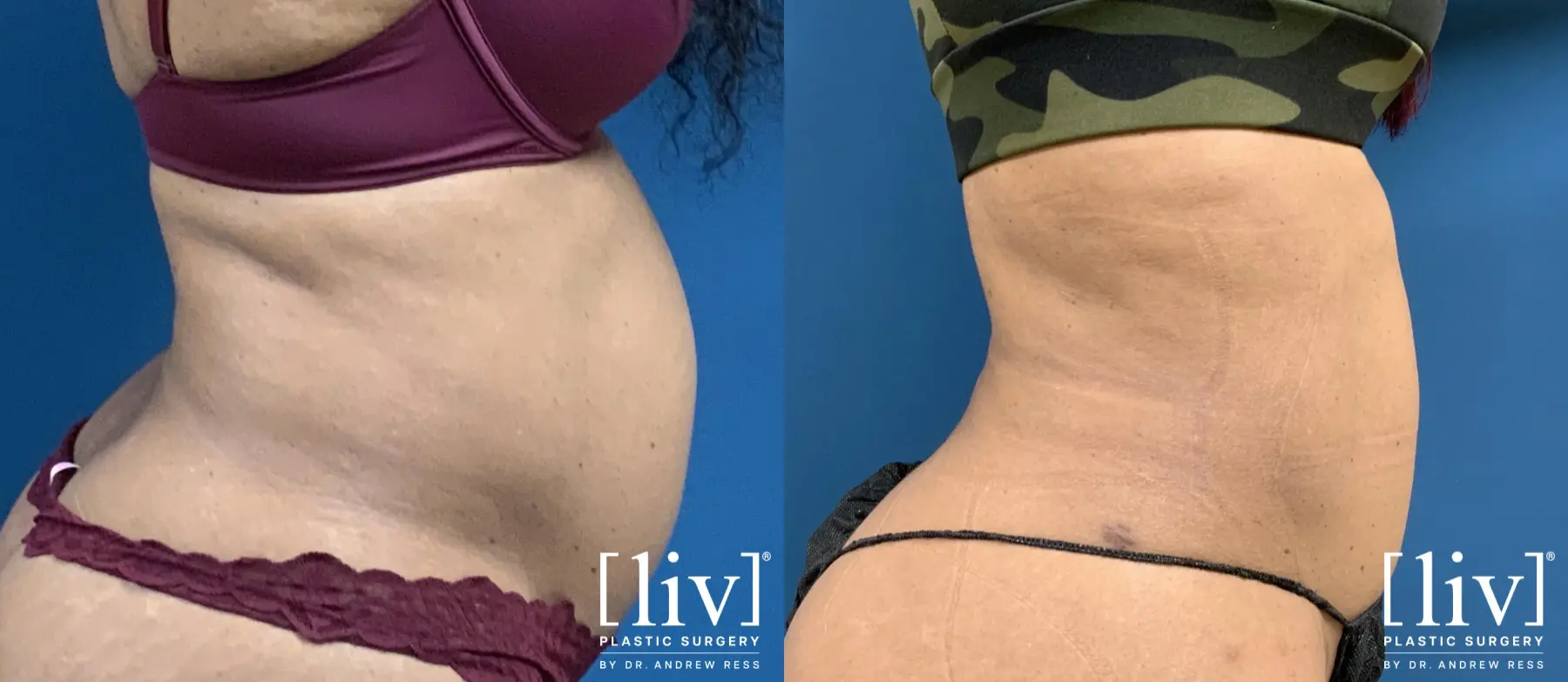 Liposuction: Patient 8 - Before and After 6