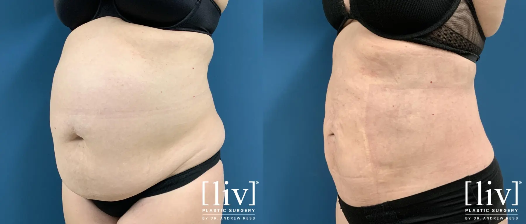 Liposuction: Patient 35 - Before and After 2