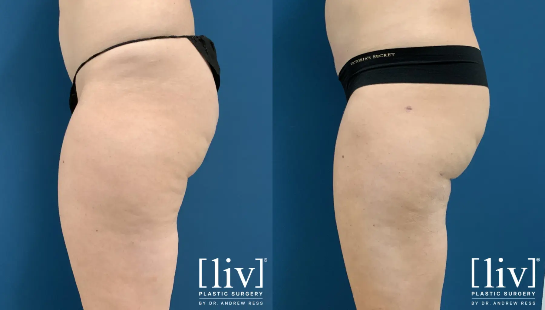 Thigh Liposuction - Before and After 2