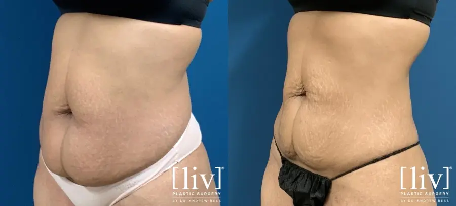 Liposuction: Patient 5 - Before and After 2