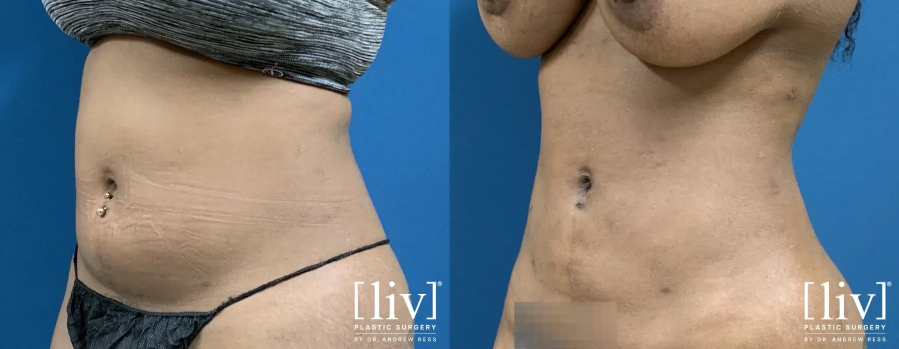 Liposuction: Patient 1 - Before and After 2