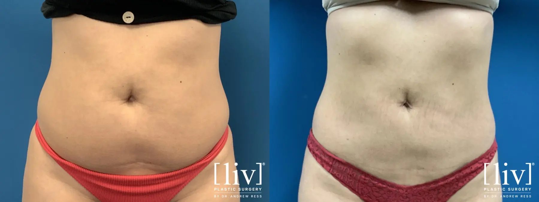 Liposuction: Patient 50 - Before and After 3