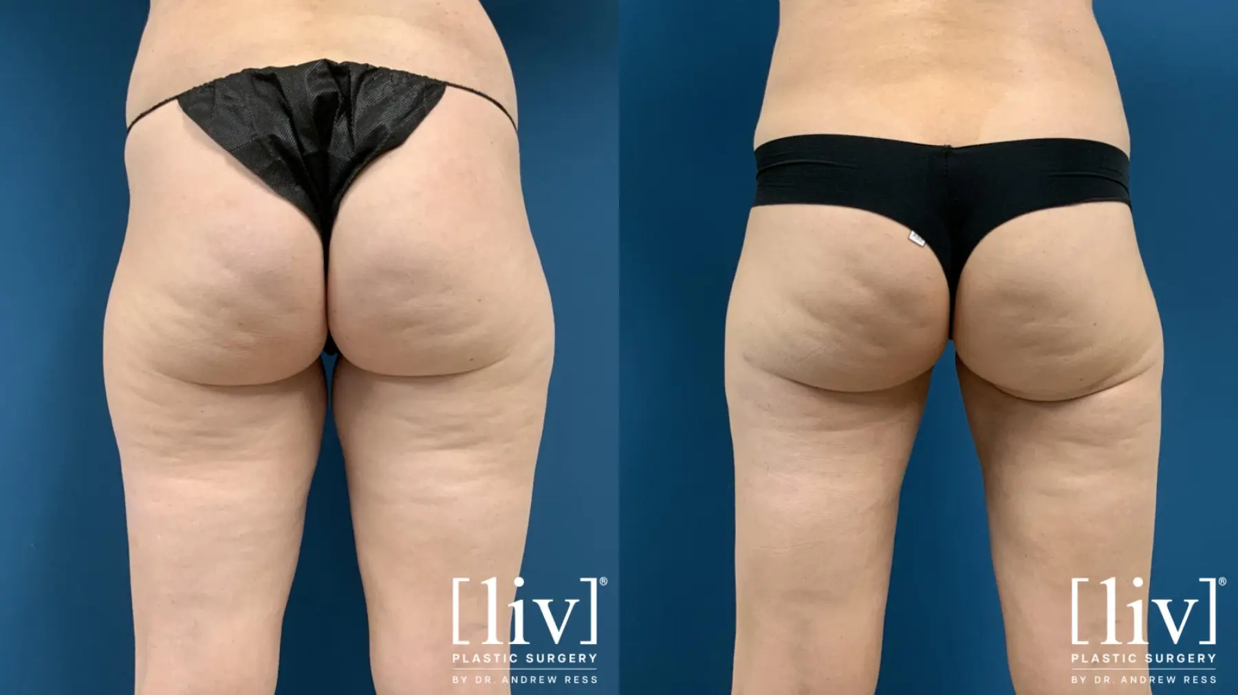 Thigh Liposuction - Before and After 1