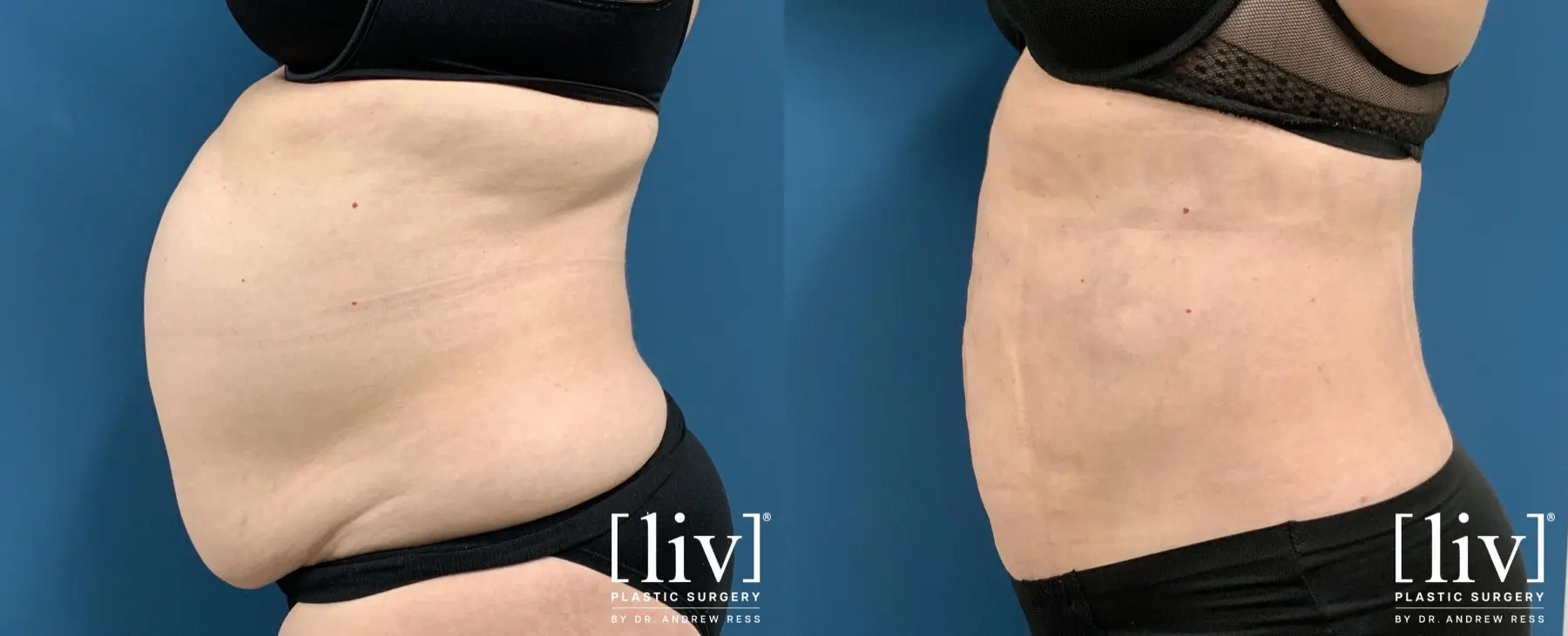 Liposuction: Patient 35 - Before and After 3