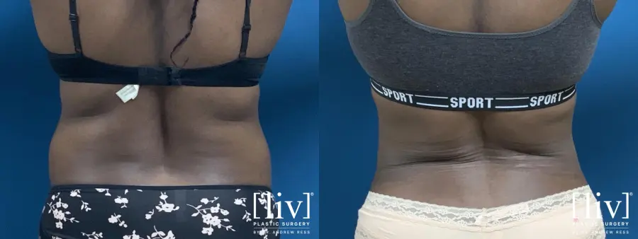 Liposuction - Before and After 6