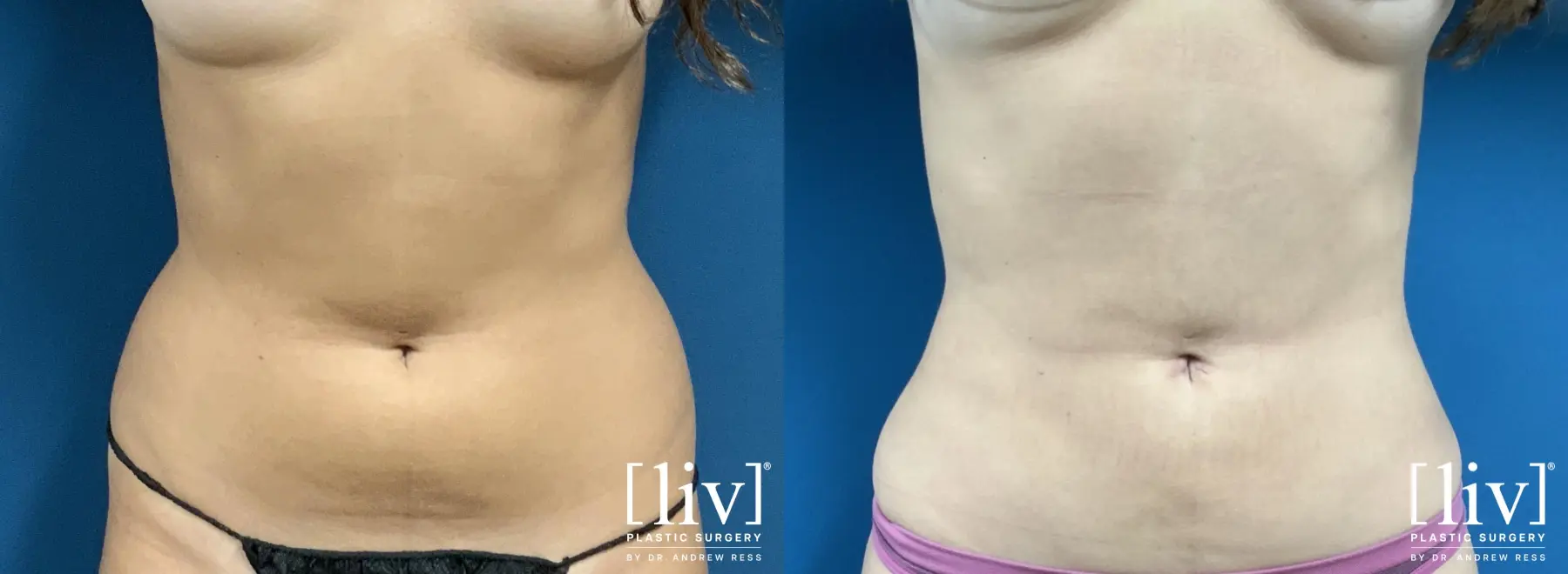 Liposuction: Patient 25 - Before and After 1