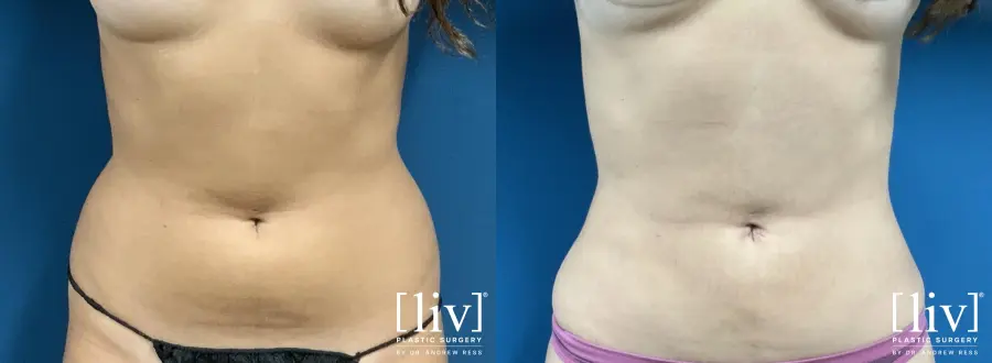 Liposuction: Patient 23 - Before and After 1