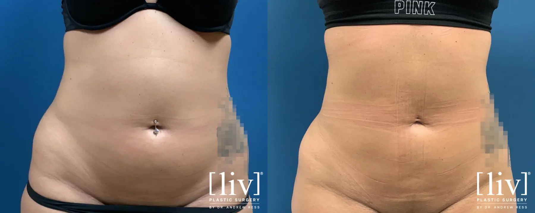 Liposuction: Patient 7 - Before and After 2