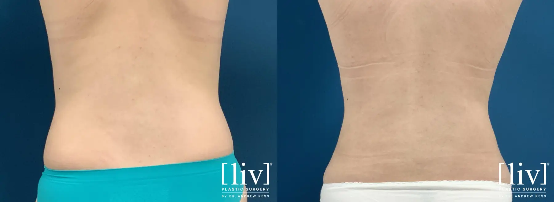Liposuction: Patient 32 - Before and After 6