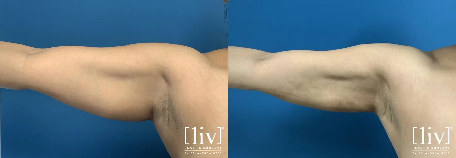 Arm Liposuction - Before and After 1