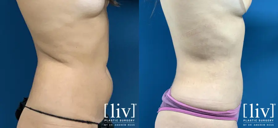 Liposuction: Patient 23 - Before and After 5