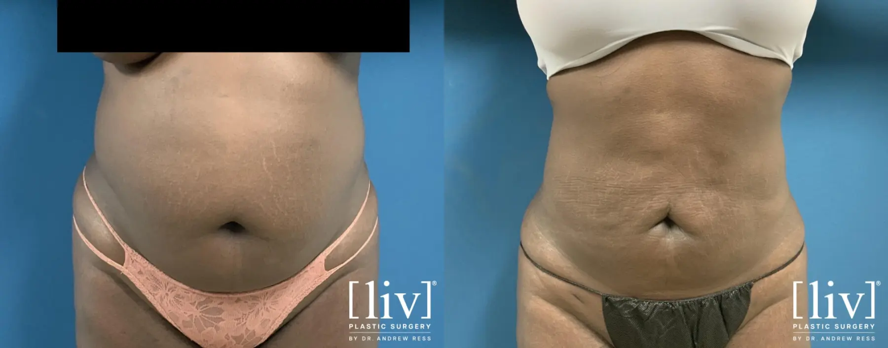 Liposuction: Patient 34 - Before and After 1