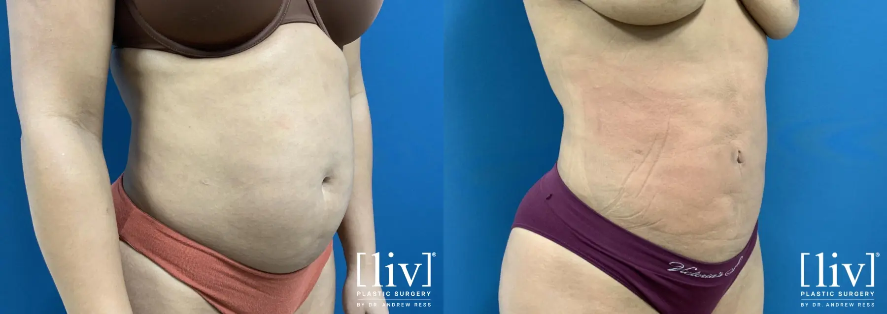 Liposuction: Patient 37 - Before and After 2
