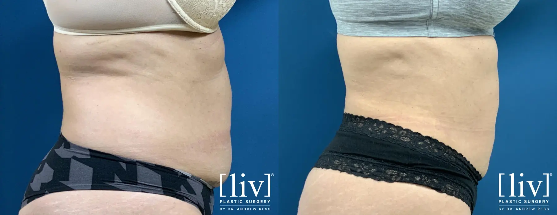 Liposuction: Patient 27 - Before and After 3