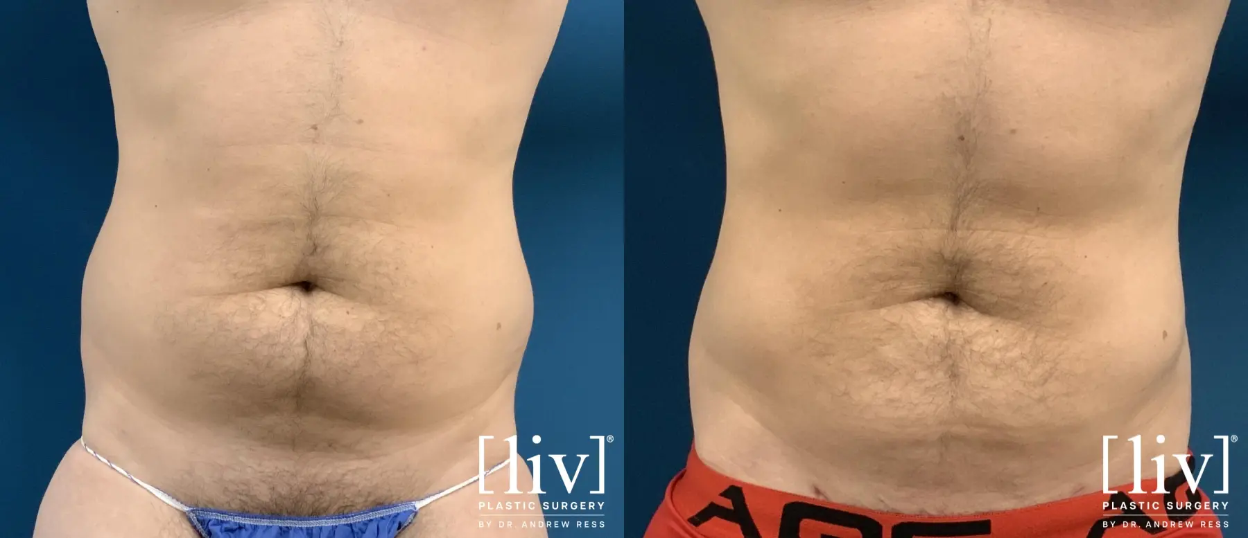 Liposuction: Patient 46 - Before and After 1
