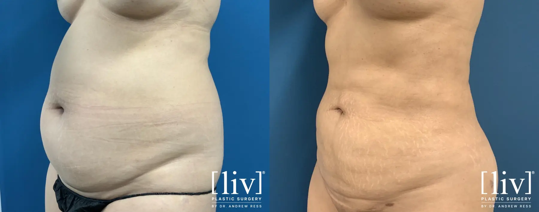 Liposuction: Patient 13 - Before and After 2