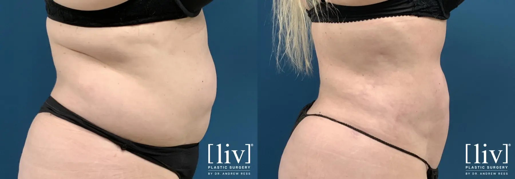 Liposuction: Patient 45 - Before and After 3